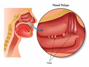 nasal polyps