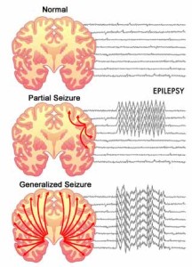 epilepsy